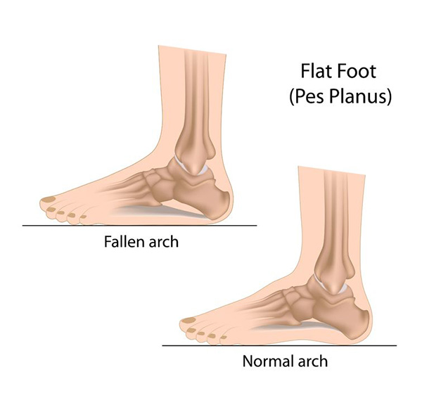 Flat Feet in Kirkland | Flat Feet Treatment in Bellevue | Seattle Flat Feet